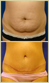 Salt Lake City tummy tuck patient photos