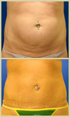 Salt Lake City tummy tuck patient photos