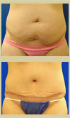 Salt Lake City tummy tuck patient photos