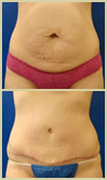 Salt Lake City tummy tuck patient photos