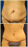 Salt Lake City tummy tuck patient photos