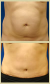 Salt Lake City tummy tuck patient photos