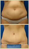 Salt Lake City tummy tuck patient photos