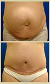 Salt Lake City tummy tuck patient photos