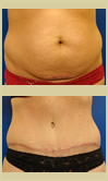 Salt Lake City tummy tuck patient photos