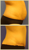 Salt Lake City tummy tuck patient photos