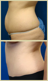 Salt Lake City tummy tuck patient photos