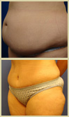 Salt Lake City tummy tuck patient photos