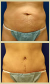 Salt Lake City tummy tuck patient photos